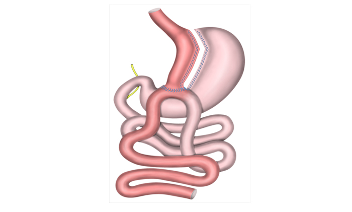 Mini Gastrik Bypass