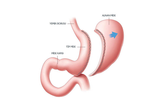Sleeve Gastrektomi (Tüp Mide)